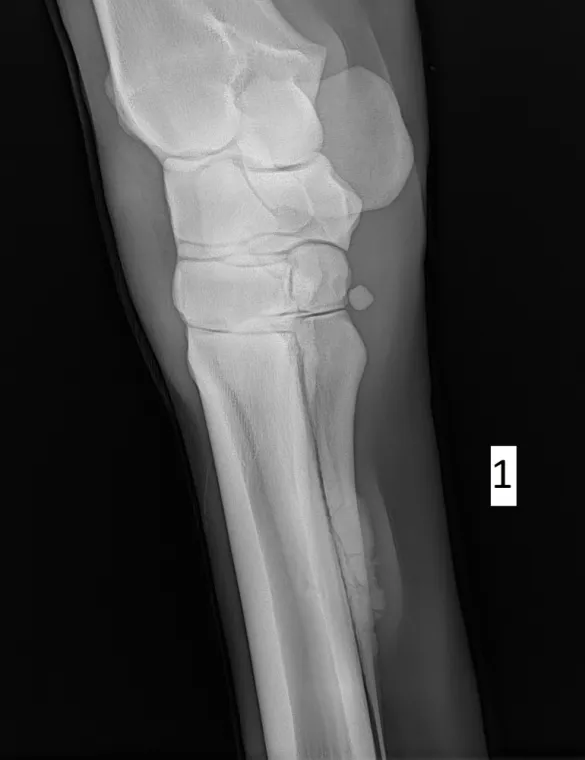 Fracture de l'os rudimentaire